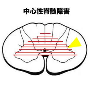 中心性脊髄 頸髄 損傷とは その症状やリハビリテーション方法は