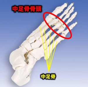 足の指の付け根が痛む 中足骨骨頭痛 とは その治療法は