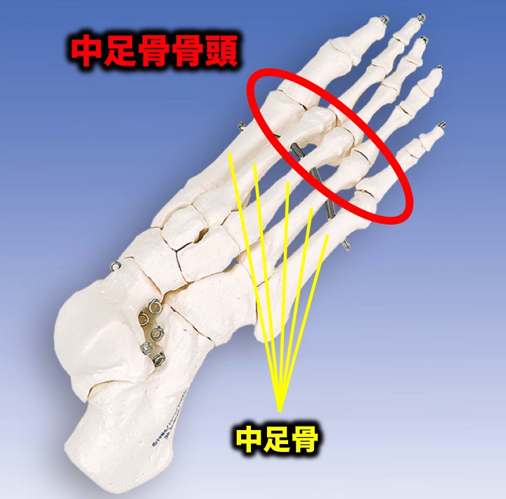 足の指の付け根が痛む「中足骨骨頭痛」とは?その治療法は?